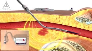 Saranas  Internal Bleeding Detection  3D Medical Animation [upl. by Alaecim]