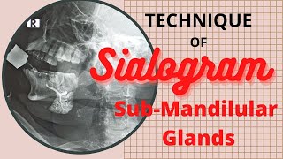 Sialogram of Sub mandibular gland Ep52  Technique of Submandibular gland  procedure Sialography [upl. by Jarita]