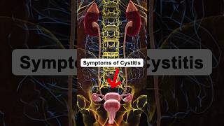 Symptoms of Cystitis cystitis health healthtips shorts [upl. by Otrebron]