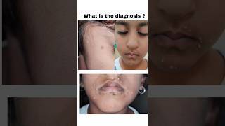 Diagnosis and treatment of Molluscum Contagiosum [upl. by Boy]