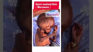 Severe malnutrition ll marasmus ll marasmus pem malnutrition baby hospital doctor surgeon mp [upl. by Golightly]