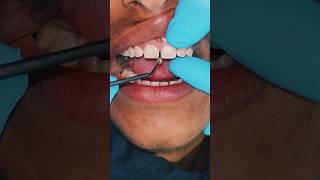 Amazing Front Teeth Gap Filling 😱 frontteethgap [upl. by Warfield]