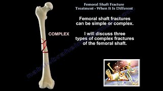 Femoral Shaft Fracture When It Is Different  Everything You Need To Know  Dr Nabil Ebraheim [upl. by Yltsew]