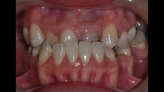 Class III Malocclusion  Underbite  La Submordida  Orthodontics Treatment  Braces [upl. by Nylireg]