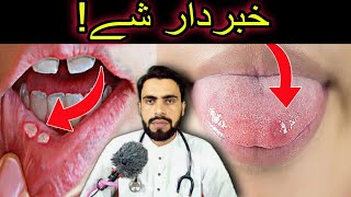 Mouth Ulcers or Canker Sore and Mouth Cancer Awareness in Pashto by Dr Mustaqeem [upl. by Arrol201]