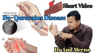 Dequervains disease  dequervains tenosynovitis  thumb pain  Dequervains syndrome testin hindi [upl. by Ayit451]