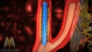 3D Medical Video HD  Carotid Artery Stenting [upl. by Elleraj737]