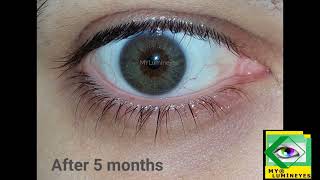 laser eye color change surgery [upl. by Albertson]