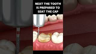 DENTAL CAP PROCEDURE  Dental cap kaise lagayi jati hai dentalcrowns teeth toothless tooth [upl. by Chrisse55]