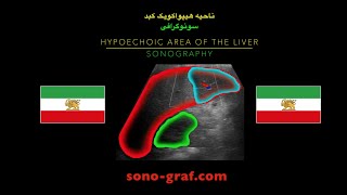 سونوگرافیناحیه هیپواکویک کبد [upl. by Taft918]