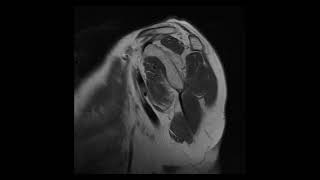 RO Chondrosarcoma proximal humerus Lt [upl. by Anidualc]