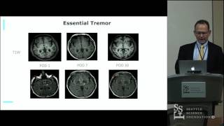 Focused Ultrasound Thalamotomy For Essential Tremor  Ryder Gwinn MD [upl. by Trent]