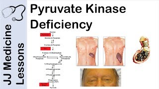 Pyruvate Kinase Deficiency  Symptoms Pathophysiology and Treatment [upl. by Mollee]