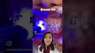 How can Braces straighten teeth [upl. by Jerrilee]