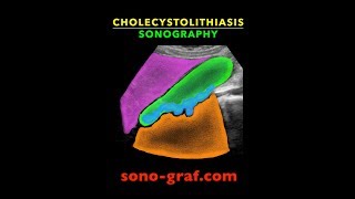 Sonography  Cholecystolithiasis [upl. by Gorga]