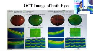 AIOCMTC2 2023 APOS Retina PPS FP673 Dr SIRIPURAPU CASE OF FOVEAL HYPOPLASIA WITH NYSTAGMUS [upl. by Tnattirb458]