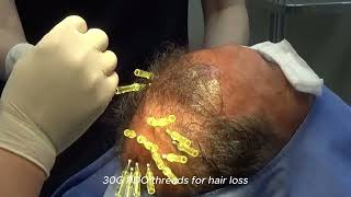 PDO thread procedure local anesthesia exosome injection for hair loss treatment [upl. by Ernaline]