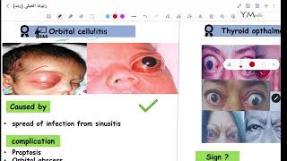 Orbital Diseases Ptosis OPH [upl. by Bratton]