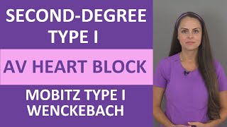 SecondDegree Type I AV Heart Block Nursing NCLEX ECG  Mobitz Type 1  Wenckebach [upl. by Elyc]