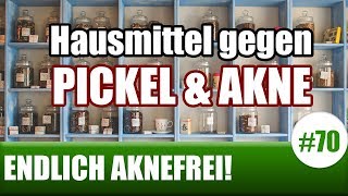 Hausmittel gegen Pickel und Akne – Meine 7 Favoriten ENDLICH AKNEFREI 70 [upl. by Aciemaj]