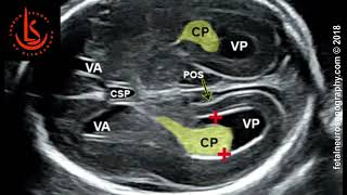 Fetal lateral ventricle measurements How to measure posterior ventricle for ventriculomegaly [upl. by Yttiy]