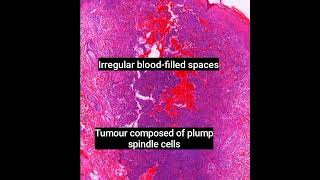 Histopathology of Aneurysmal Dermatofibroma dermpath dermatopathology pathology shorts [upl. by Bertie]