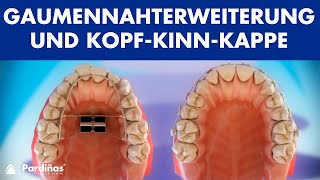 Kieferorthopädie  Gaumennahterweiterung und KopfKinnKappe © [upl. by Anibor591]