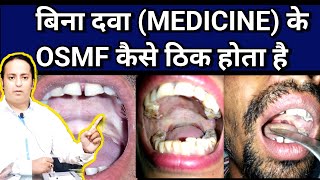 ये कैसे हो सकता है  SubMucous Fibrosis ।। OSMF ।। OSMF Medicine ।। OSMF Exercise ।। dramitkdubey [upl. by Siramaj]