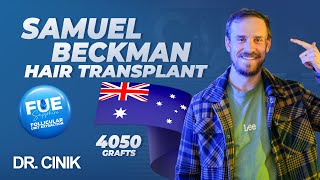 Sam Beckman  Hair Transplant FUE  Dr Cinik [upl. by Barlow]