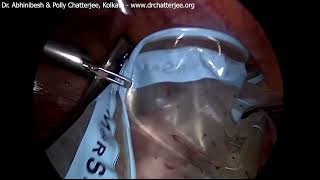 Laparoscopic fundal pedunculated subserous myomectomy  in bag morcellation [upl. by Connell]