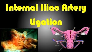 Internal Iliac Artery Ligation  Internal Iliac artery Ligation Procedure [upl. by Anitac542]