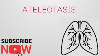 Atelectasis  types and causes [upl. by Amsirhc]