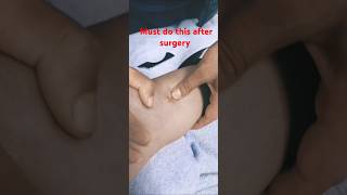 Surgery ki bad scar mobilization zarur karain  Surgery  scars [upl. by Eninej]