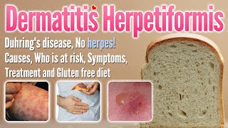 Dermatitis herpetiformis Causes Symptoms Treatment and glutenfree diet list  Duhring’s disease [upl. by Cuda]