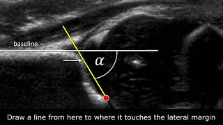 Congenital Hipdysplasia  How to measure angles [upl. by Ardnuyek]