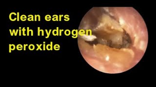 Clean ears with hydrogen peroxide [upl. by Denman287]