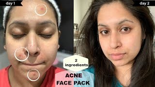 ব্রণ চলে যাবে ২ দিনেই DIY ACNE FACE PACK only with 2 ingredients  Shahnaz Shimul [upl. by Schubert]