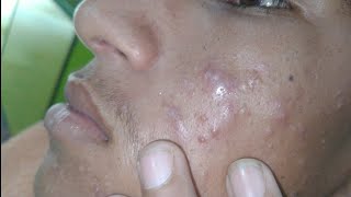 sac be spa blackheads elderly 2024  sac be spa old age blackheads 2024  sac be spa face scrub 993 [upl. by Gardol874]