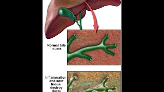 Primary Sclerosing Cholangitis [upl. by Yves]