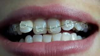 aparat ortodontyczny ESTETYCZNY szafirowy shappire braces [upl. by Refiffej759]