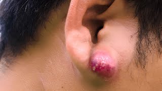 Ear Abscess [upl. by Arriec612]