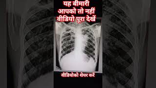 chest Xray youtuber youtubeshort [upl. by Attenna342]