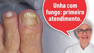 UNHA COM FUNGO PRIMEIRO ATENDIMENTO [upl. by Ylac]