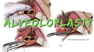 Alveoloplasty [upl. by Saidel902]