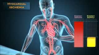 Understanding the energetic mechanisms that cause angina pectoris [upl. by Gnauq45]