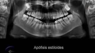 Anatomía en la radiografía panorámica II Anatomic panoramic image II [upl. by Ztnaj]