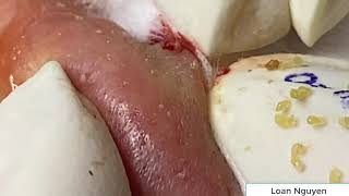 Blackheads extraction with Loan Nguyen Spa n10 [upl. by Mignonne]