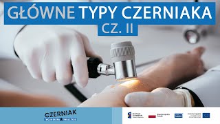 Główne typy czerniaka  cz 2 [upl. by Salomone]