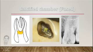 How to manage calcified chamber and canals during RCT [upl. by Etnaud671]