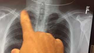 pneumonia on xray [upl. by Urquhart]